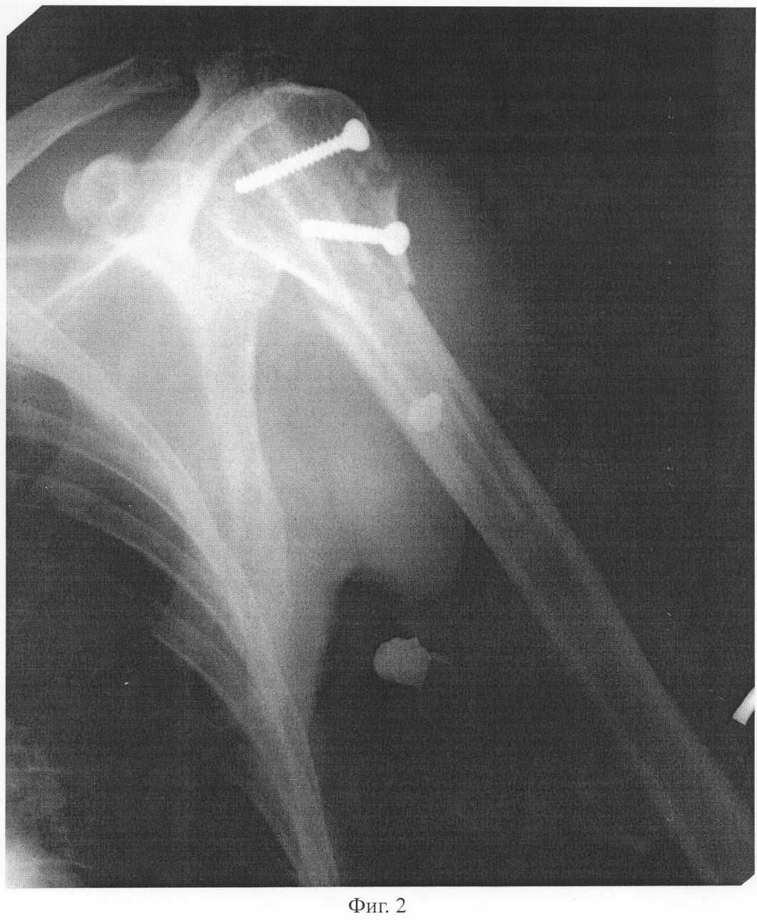 перелом плечевой кости фото