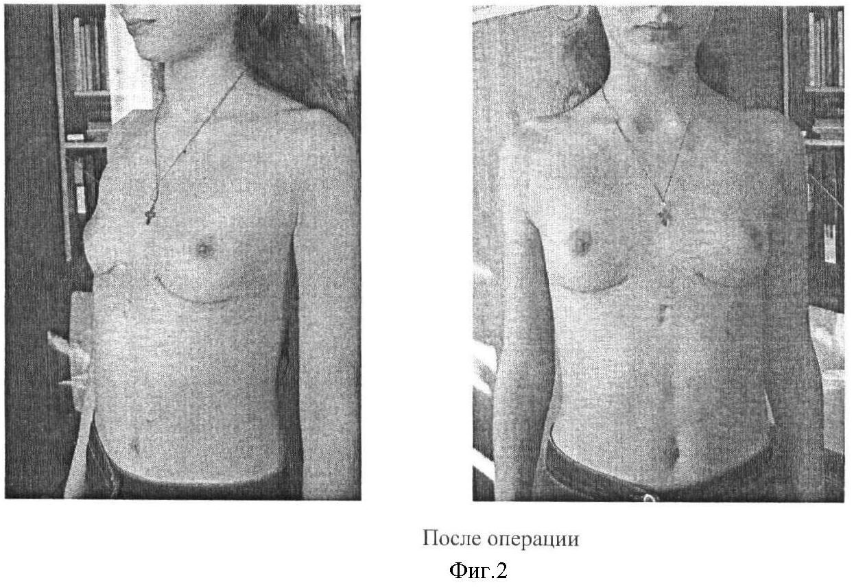воронкообразная грудь у женщин фото 20
