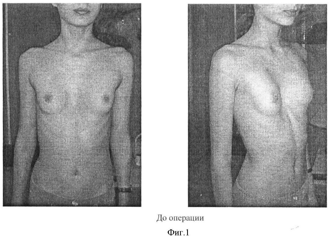 воронкообразная грудь у женщин фото 91
